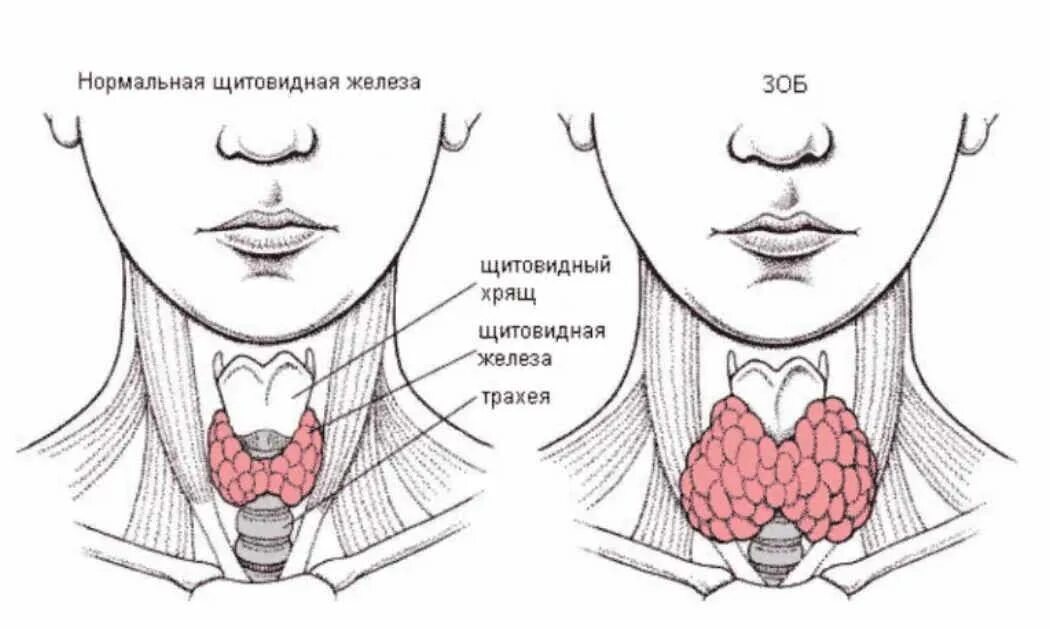 Где зоб. Узловой зоб щитовидной железы. Диффузный эндемический зоб. Зоб 1 степени щитовидной железы что это. Струма щитовидной железы.