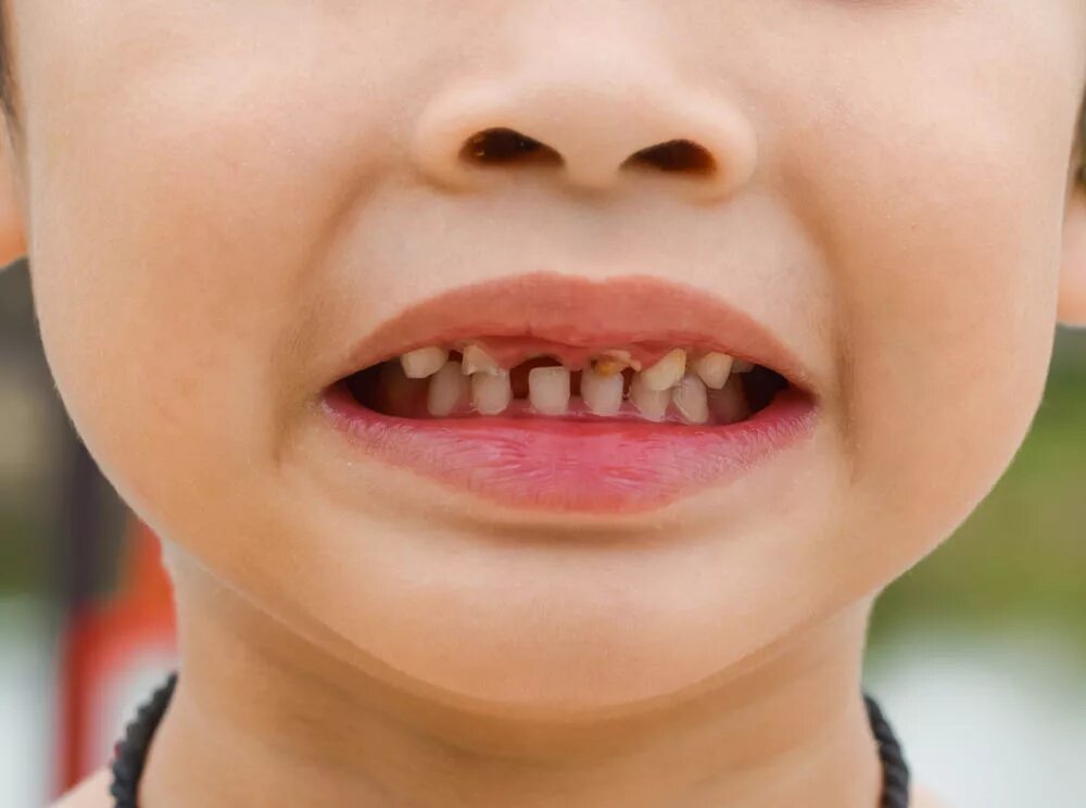 Ребенку 2 года 12 зубов