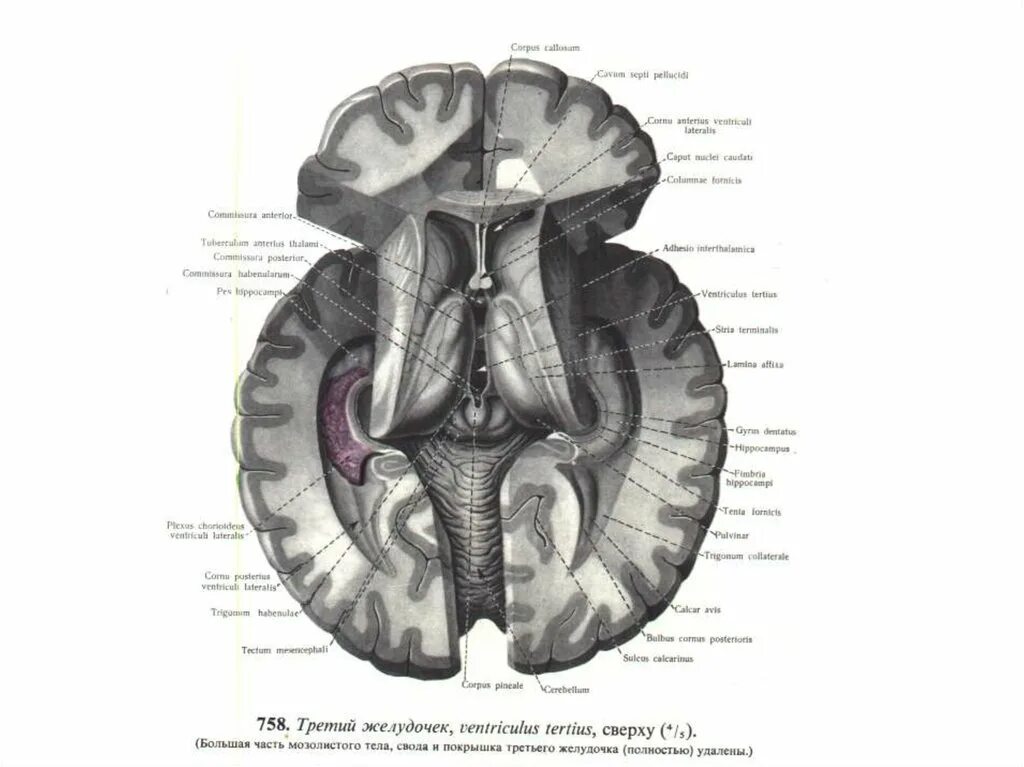 Стенки 3 желудочка мозга. Содержимое 3 желудочка. Боковые желудочки 4 желудочка головного мозга. Боковые желудочки анатомия кт. Стенки 3 желудочка мозга.