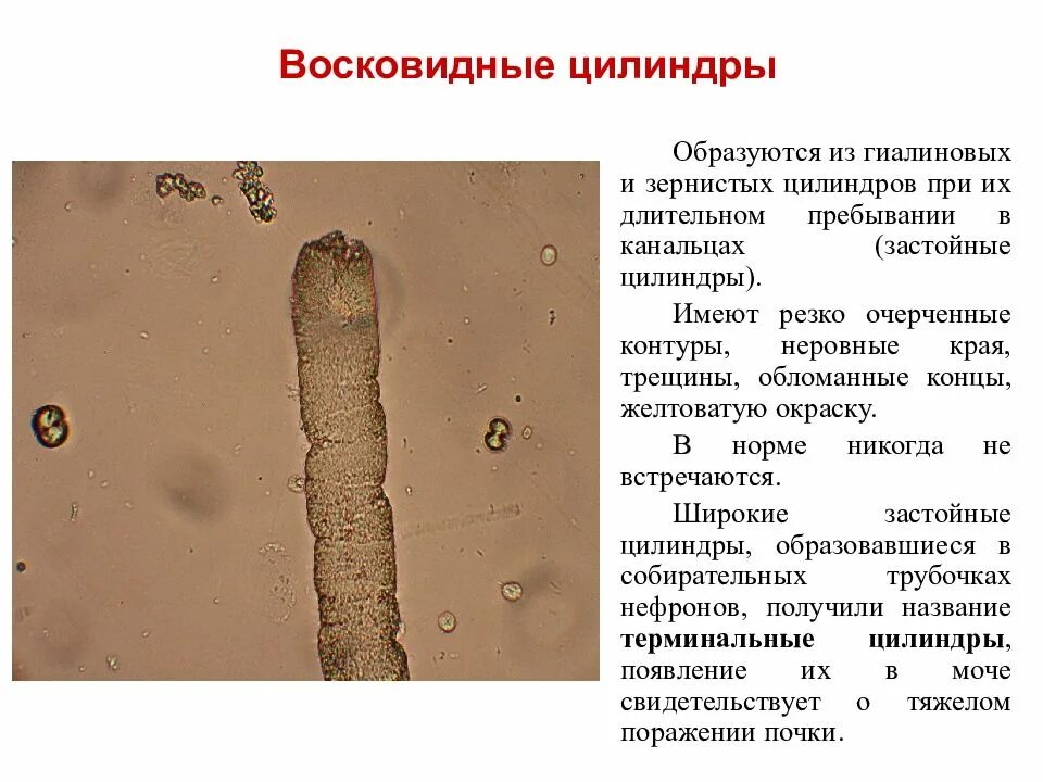 Повышены цилиндры в моче. Микроскопия мочи цилиндры восковидные. Гиалиновые цилиндры микроскопия. Восковидные цилиндры в моче. Цилиндры гиалиновые зернистые восковидные.