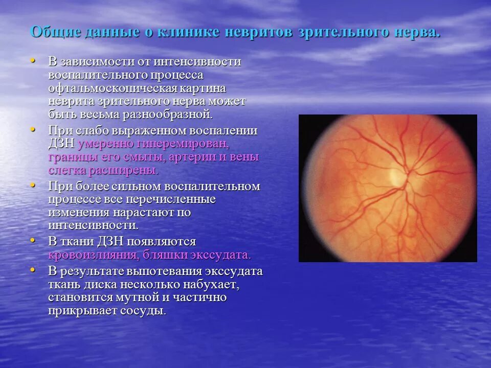 Ретробульбарный неврит (папиллит). Клиника поражения зрительного нерва. Неврит зрительного нерва и ретробульбарный неврит. Ретробульбарный неврит зрительного нерва клиника. Ишемия нерва