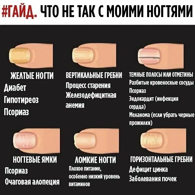 Пятно на ногте указательного пальца. Продольные и поперечные борозды на ногтях. поперечные полоски на ногтях. ногти с полосками. поперечная и продольная исчерченность ногтей.