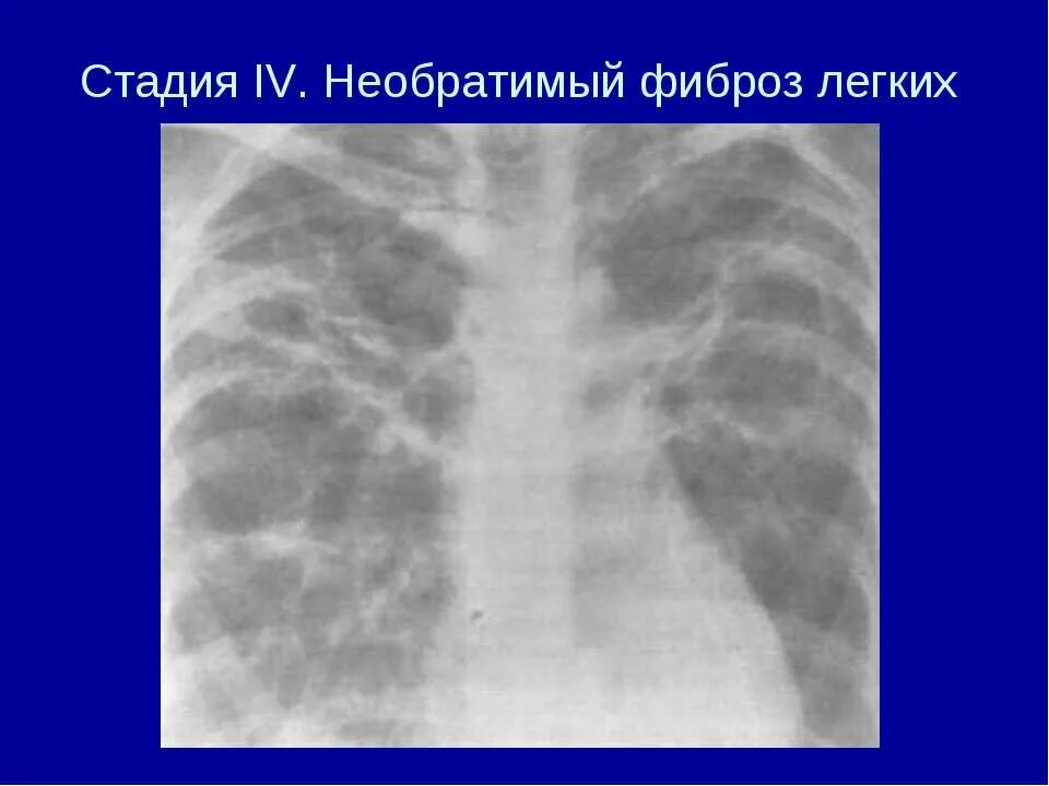 Умеренные фиброзные изменения. Фиброзные тяжи в легких рентген. Fibroz lyogkix.