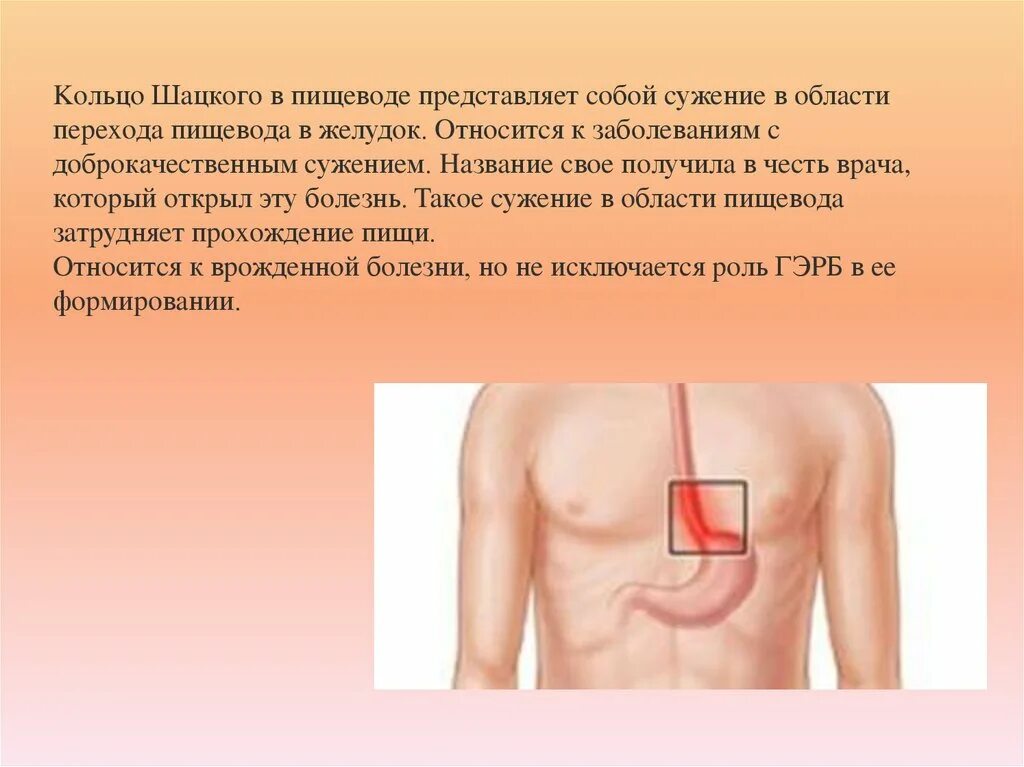 Кольцо шацкого в пищеводе что это. Кольцо шацкого в пищеводе что это