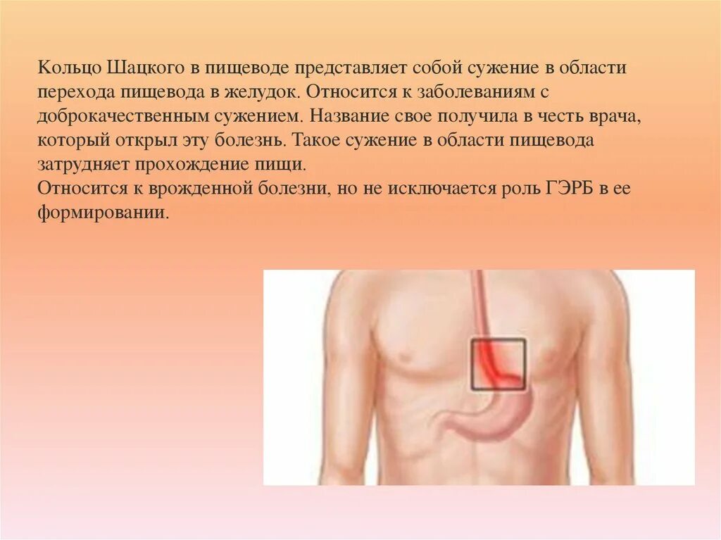 Кольцо шацкого в пищеводе