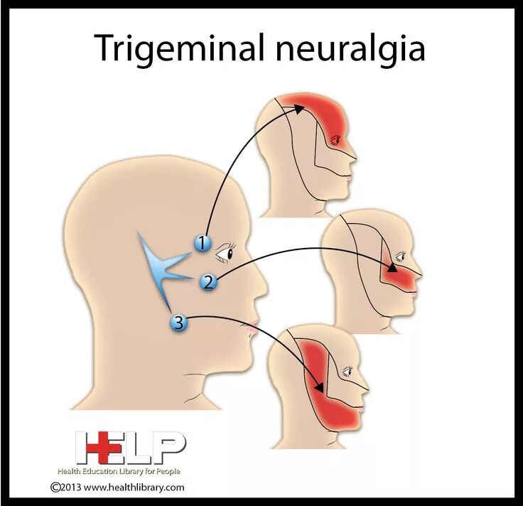 Neuralgia латынь. Trigeminal neuralgia. невралгия тройничного нерва. тригеминальная невралгия тройничного нерва. невралгия тройничного нерва картинки.