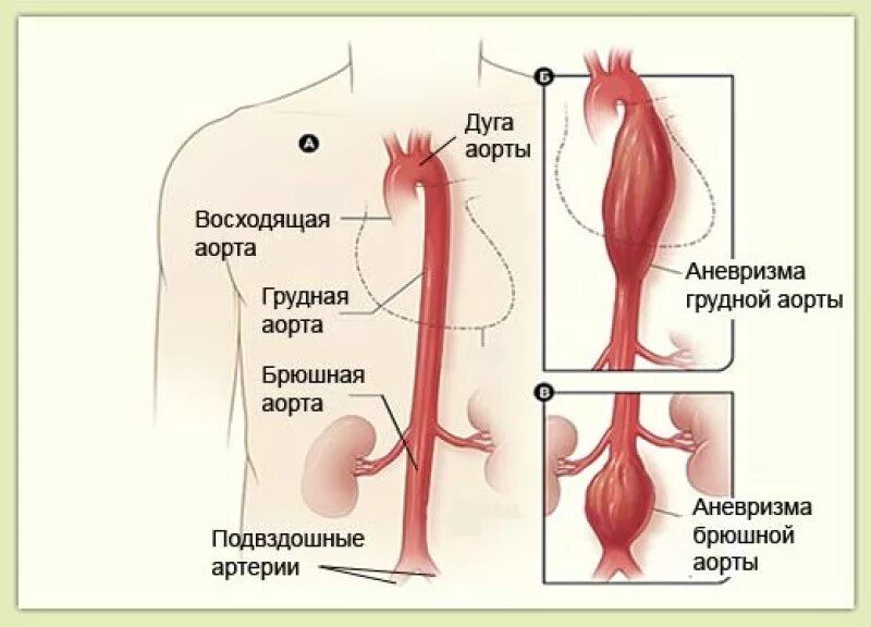 Аневризма сердца что это такое симптомы. Аневризматическое расширение брюшного отдела аорты. Аневризма брюшной отдел аорты отделы. Аневризмы брюшного отдела аорты. Аневризма восходящего отдела аорты критерии.