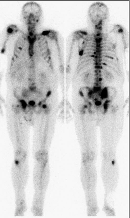 Метастатическое поражение кости. Сцинтиграфия костей метастазы. Сцинтиграфия метастазы в кости. Остеосцинтиграфия метастазы. Остеосцинтиграфия костей метастазы.