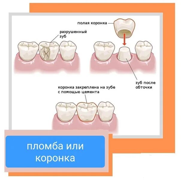 Схема установки коронки. Когда ставят коронку на зуб. Коронка ставится на пломбу.