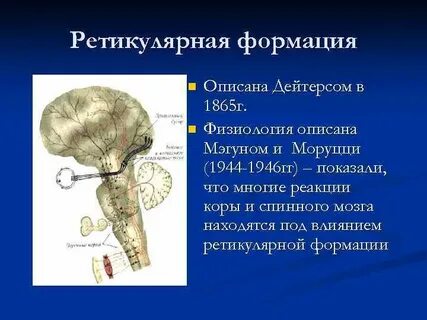 Инсульт ствола головного мозга