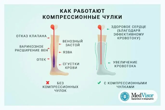 Зачем чулки перед операцией. Чулки послеоперационные компрессионные. Как работают компрессионные чулки. Компрессионные гольфы после операции. Компрессионные чулки при операции.