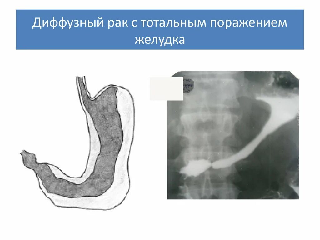 Диффузно-инфильтративная опухоль желудка. Опухоль желудка рентген. Тотальное поражение желудка. Диффузно инфильтративная