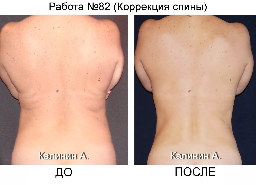 Бодилифт операция до и после фото 10. Установка бодилифта (часть первая, подготовка). Mitsubishi Pajero Sport (2