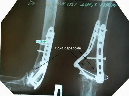 Остеосинтез операция пластины