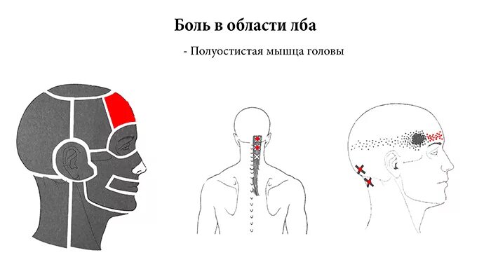 Болит в висках. Боли в голове в области. Головная боль в височной области. Болит голова в Виске.