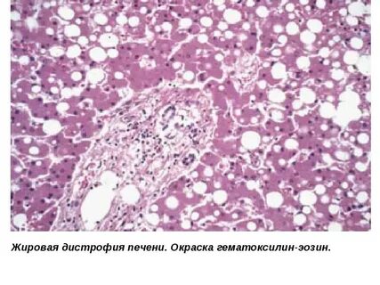 Дистрофия печени и почек