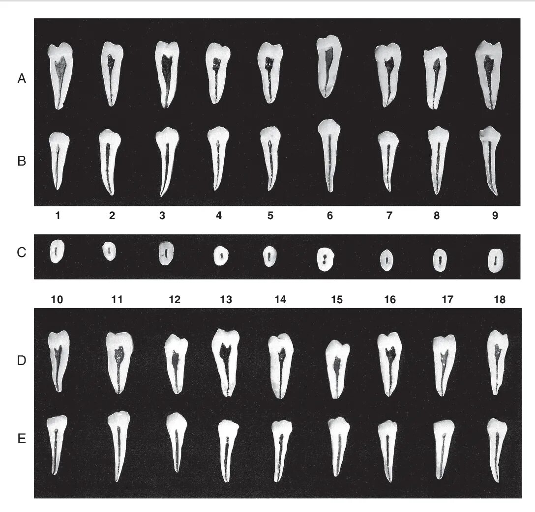 Анатомия и топография корневых каналов. Топография корневых каналов зубов. Формы корневых каналов