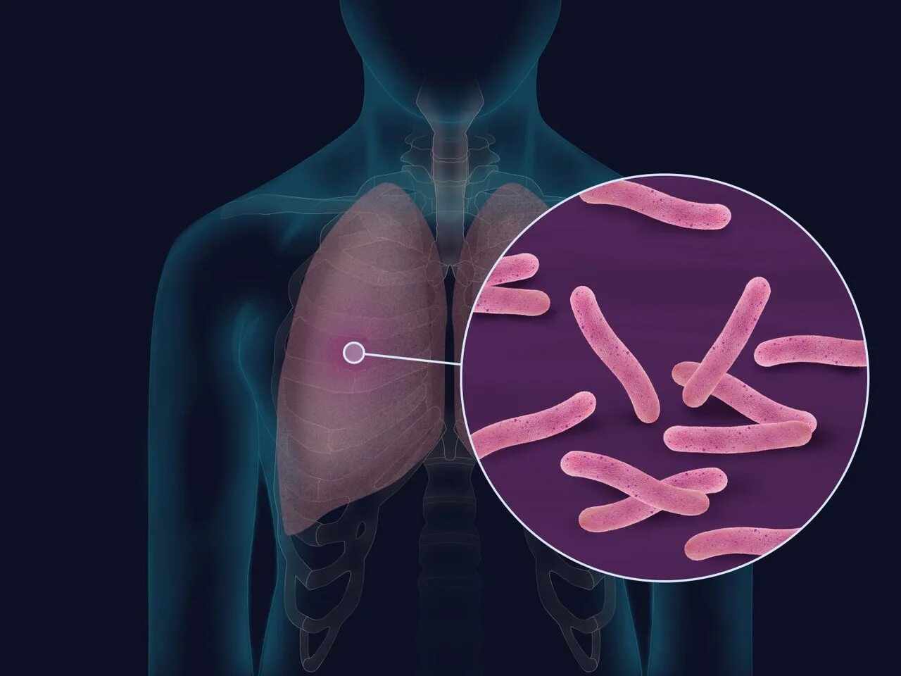 Туберкулез tuberculosis. Мукобактериум туберкулез. Возбудитель туберкулеза. Возбудитель туберкулеза легких. Микобактериум туберкулезис.