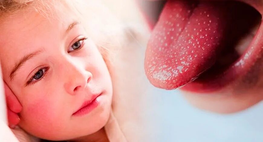 Сыпь температура боль в горле у ребенка. Стрептококковая скарлатина. Скарлатина стрептококк.