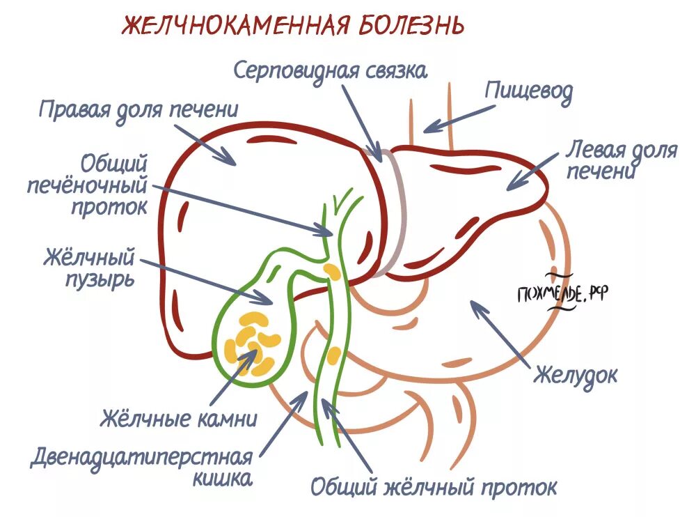 Желчекаменная болезнь схема. Схема формирования желчных камней. Схема образования камней в желчном пузыре. ЖКБ патогенез схема.