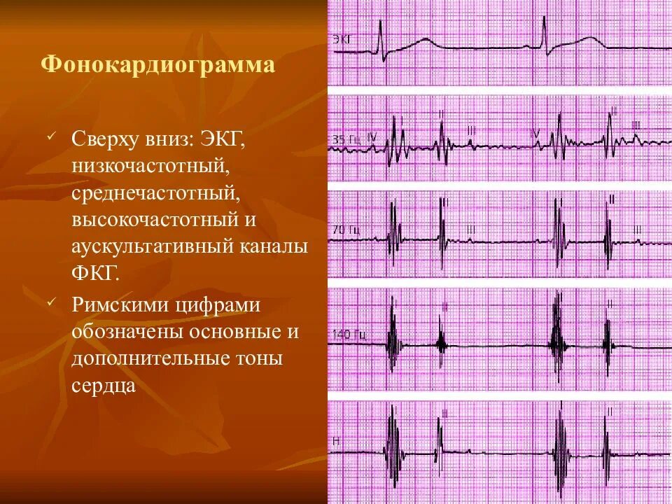 Графическое изображение фкг. Фонокардиография (фкг). тоны сердца на фкг. тоны сердца фонокардиография. нормальная фкг.
