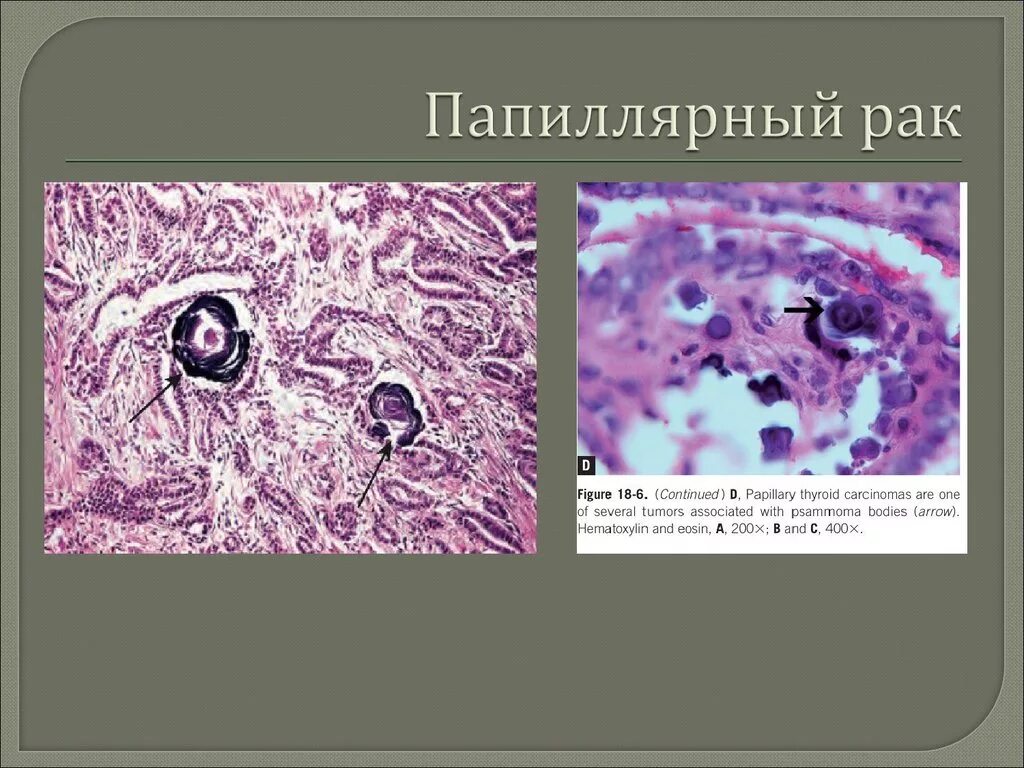 Папиллярная карцинома гистология. Аденокарцинома щитовидной железы микропрепарат. Папелярная кальцеома щетавидной железы. Папилярныйрак щитовидной железы. Папиллярный рак после операции