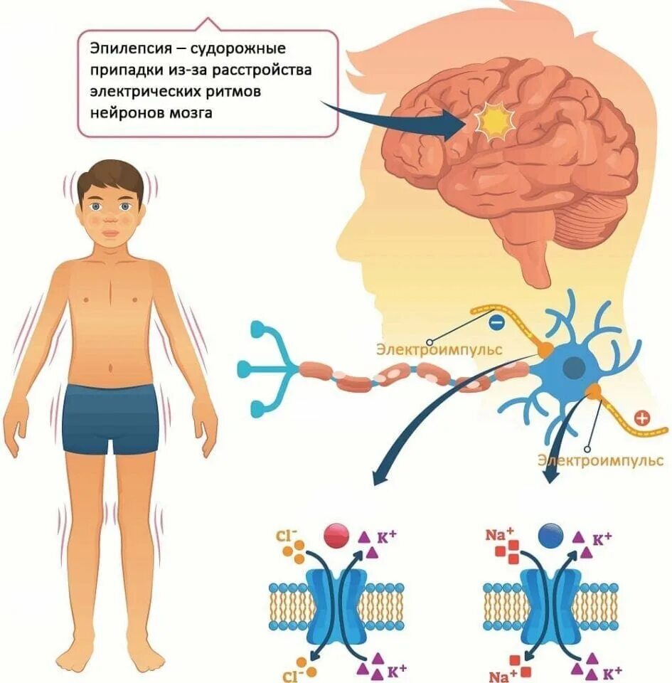 Приступ судорожной эпилепсии. Профилактика эпилепсии. Эпилепсия презентация. Профилактика эпилептических приступов.