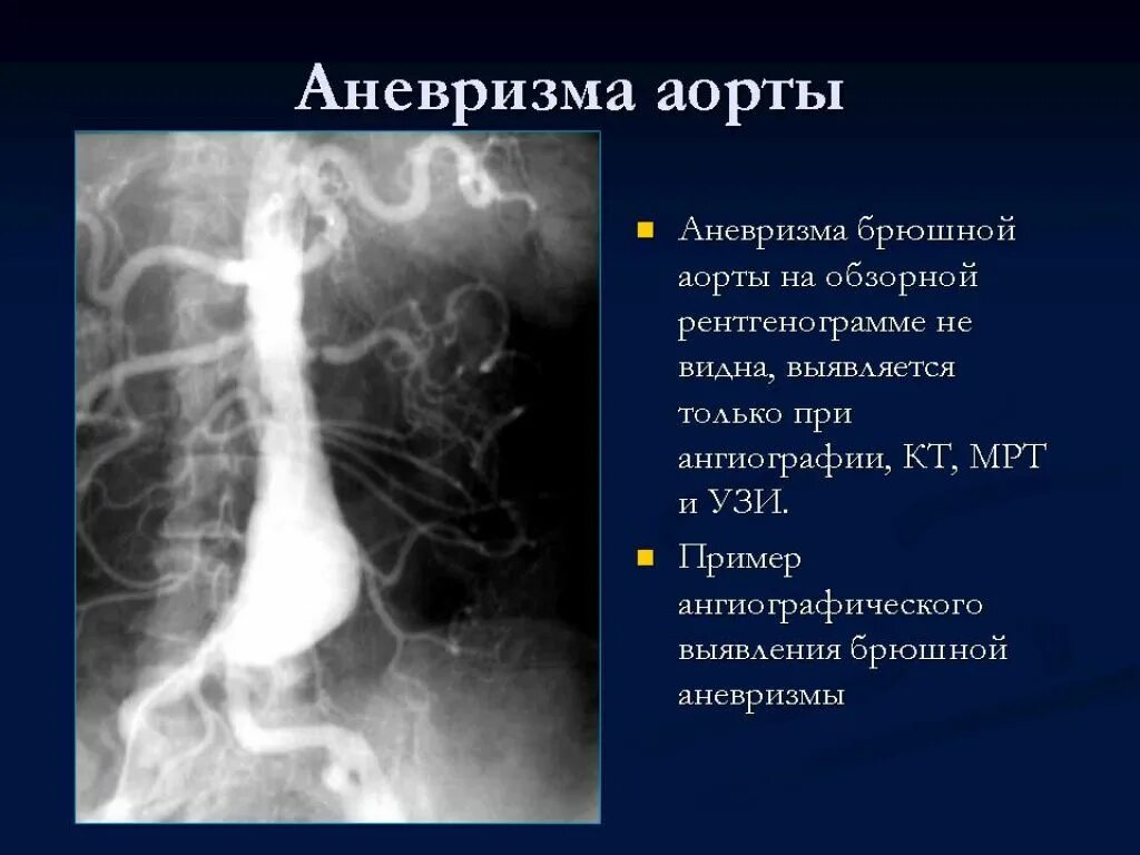 Аневризма аорты сердца что это симптомы лечение. Веретенообразная аневризма аорты. аневризма брюшной аорты. аневризм брюшной аорты. рентгенография брюшной аорты.