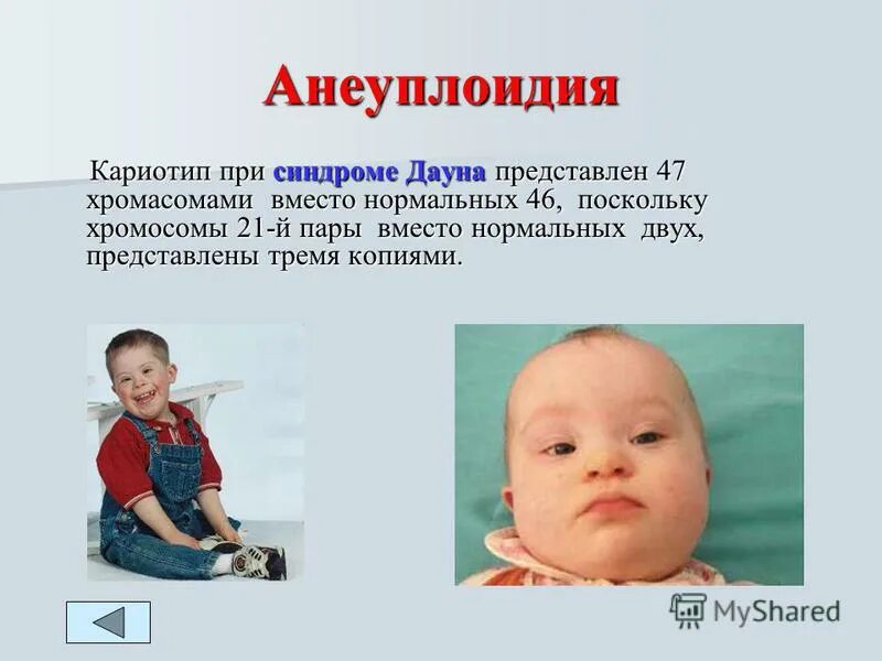 Изменения при синдроме дауна. Изменения при синдроме дауна. Синдром дауна. Синдром дауна характеристика. Синдром дауна симптомы и кариотип.
