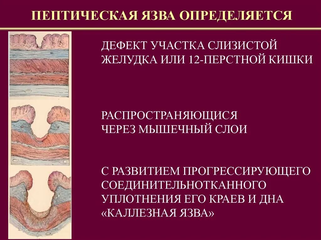 Хирургическое лечение язвы. Пенетрирующая язва желудка. Пептическая язва желудка. Язвенный дефект желудка. Каллезная пенетрирующая язва желудка.