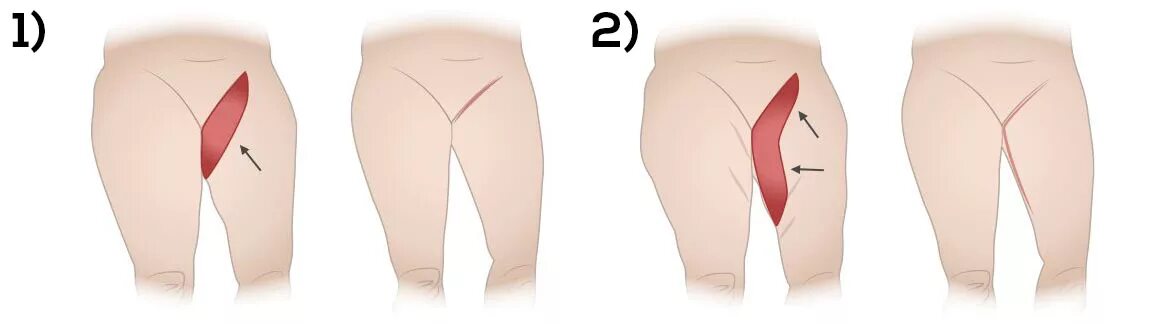 Подтяжка внутреннего бедра. Феморопластика операция. Феморопластика пластика бедер. Баттерфляй операция подтяжка ягодицы. Подтяжка бедер феморопластика.
