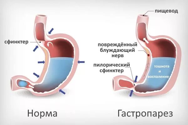 Желудочный диабет. Хирургическое лечение сахарного диабета 2 типа. Гастропарез при сахарном диабете. Поджелудочная железа и желудок анатомия. Желудочный диабет.