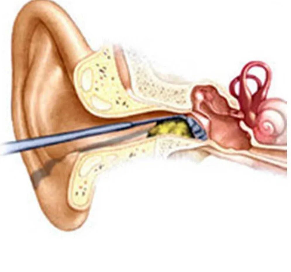 Как прочистить ухо от серной. Строение уха человека серная пробка. Наружный слуховой проход серная пробка. Строение уха ушная пробка. Гиперсекреция ушной серы.