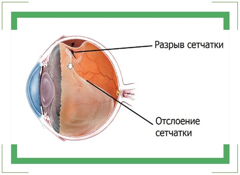 Отслоение сетчатки клиника. Отслойка сетчатки глаза коагуляция. Периферическая отслойка сетчатки. Верхняя отслойка сетчатки.