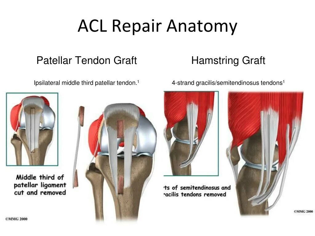 Acl что это. Hamstring tendon трансплантат. Хамстринг анатомия.