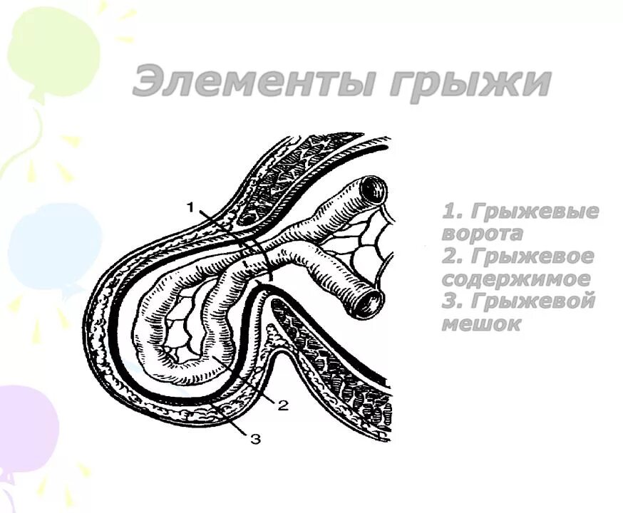 Пупочная грыжа по мкб 10 у взрослых. Составные части грыжи. Строение грыжевого мешка.. Грыжевые ворота пупочной грыжи. Послойное строение грыжи. Пупочная грыжа строение.