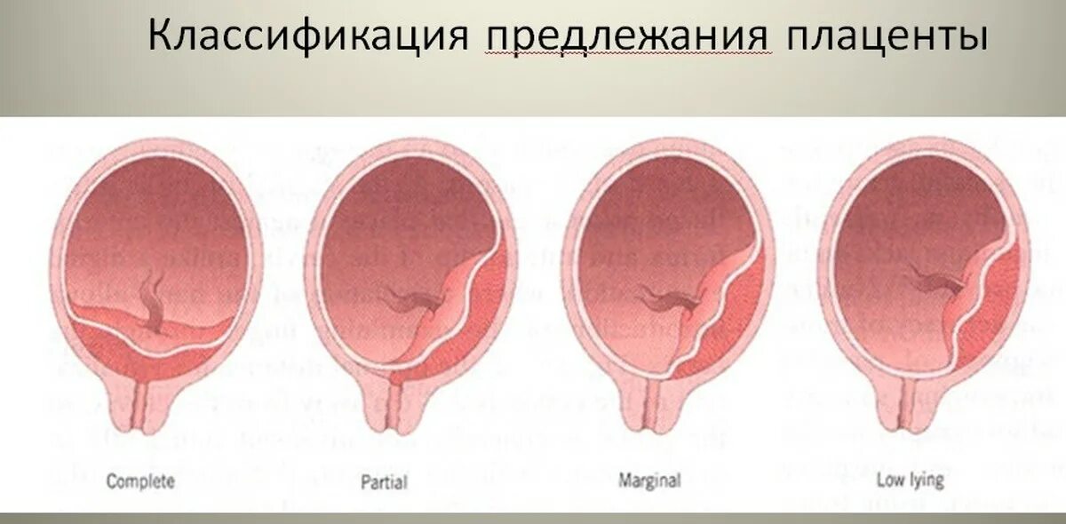 Полное предлежание форум. Краевое и центральное предлежание плаценты. Плацента краевое предлежание плаценты. Плодовый фактор предлежания плаценты. Центральное боковое и краевое предлежание плаценты.