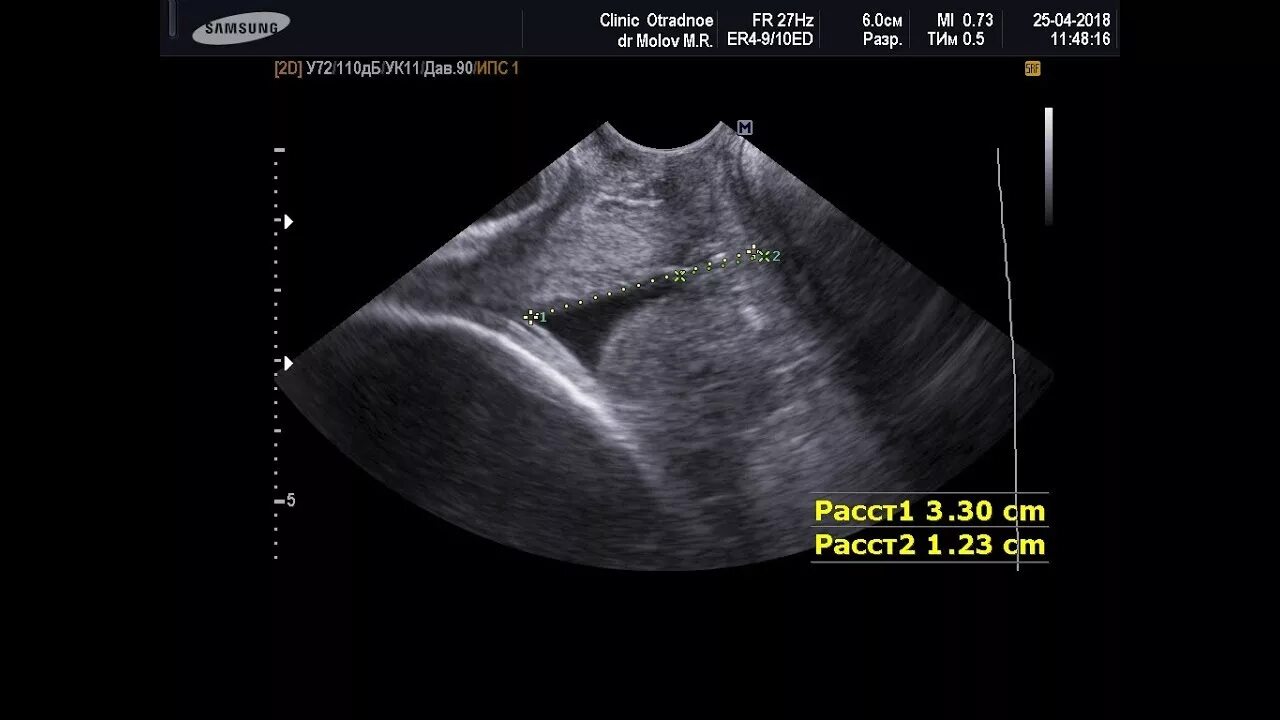 ИЦН при беременности УЗИ. Истмико-цервикальная недостаточность на УЗИ. УЗИ цервикометрия. Цервикальный канал размеры