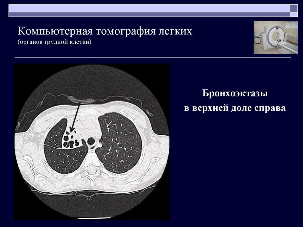Диаметр дуги аорты на кт. Мультипланарная реконструкция кт. Парааортальные лимфоузлы на кт. Бронхоэктазы на кт. Измерение лимфоузлов на кт.