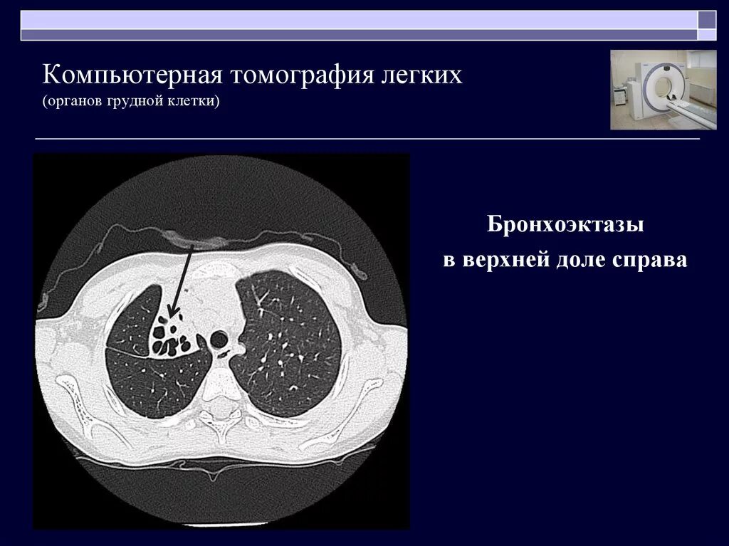 Доли легкого на кт. Компьютерная томография легких. Компьютерная томография органов грудной клетки. Кт лёгких. Легкие на кт.