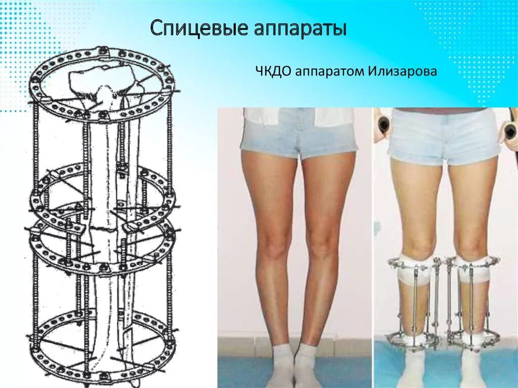 Элезаррва аппарат Илизарова. Аппарат Илизарова травматология. Компрессионно-дистракционный аппарат Илизарова. Аппарат Илизарова стержневой аппарат. На сколько можно удлинить
