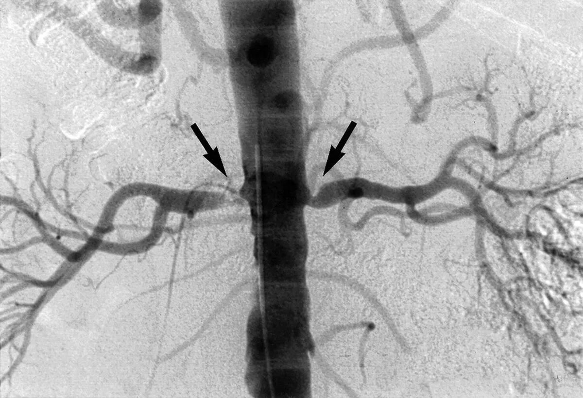 Диффузные сосуды. Кт ангиография почечных артерий. Атеросклероз почечных артерий кт. Фибромускулярный стеноз почечной артерии. Селективная ангиография аневризма.