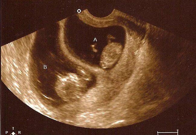 УЗИ двойняшек на 11 неделе беременности. Эмбрион по УЗИ 11 недель. Сколько будет 11 недель