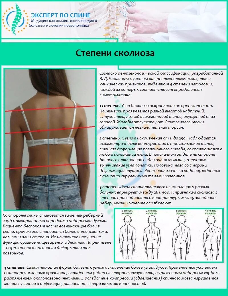 Степени сколиоза. При искривлении позвоночника. Степени деформации позвоночника при сколиозе. Искривление позвоночника талия.