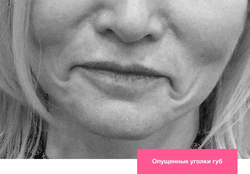 Поднятие уголков губ ботоксом. Поднятие опущенных уголков губ. морщины опущенные уголки губ.