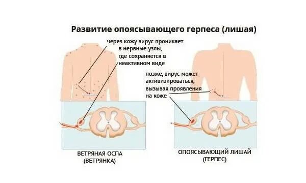 Сколько длится зуд. Опоясывающий герпес пятно. Опоясывающий герпес начальная стадия. Опоясывающий лишай межреберная. Опоясывающий лишай неврология.
