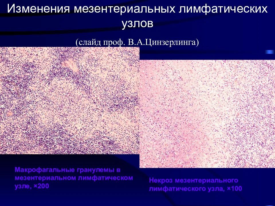 Инфекции лимфатических узлов. Брюшнотифозные гранулемы. Макрофагальные гранулемы. Лимфатический узел патологическая анатомия. Лимфатический узел при брюшном тифе.