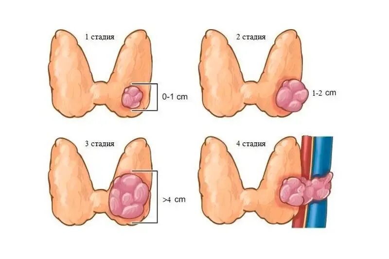 Злокачественная опухоль щитовидной. Опухоль щитовиднойсжелезы. Карцинома щитовидной железы. 4 стадия злокачественная