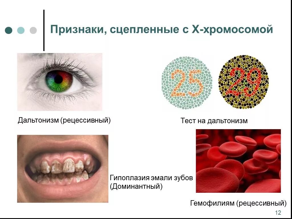 Ген общей цветовой слепоты. Признаки сцепленные с х хромосомой. Болезни человека сцепленные с полом. Болезни сцепленные с х хромосомой. Наследственные заболевания сцепленные с х хромосомой.