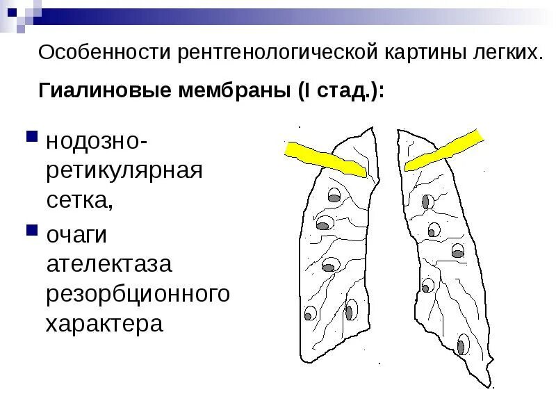 Ретикулярные изменения это. Гиалиновые мембраны в легких. ретикулярные изменения в легких. болезнь гиалиновых мембран.